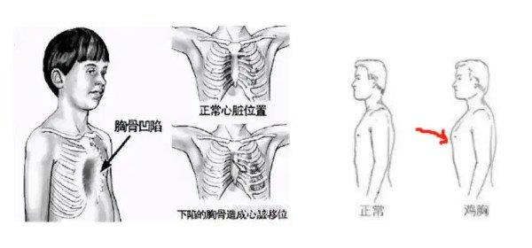 鸡胸肉和正常人区别图片